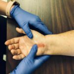 Hand with a scar being massaged by Occupational Therapist Kristen Webb.