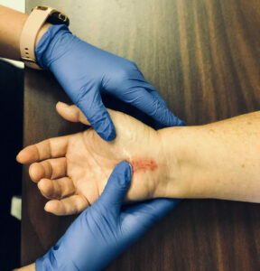 Hand with a scar being massaged by Occupational Therapist Kristen Webb.